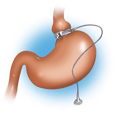 Anneau gastrique : définition, avantages et effets secondaires