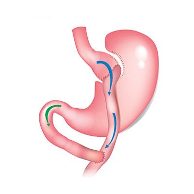 Bypass : que faut-il savoir sur cette technique chirurgicale ?